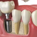 Dental Implants: Why They Are The Best Solution For Damaged Teeth
