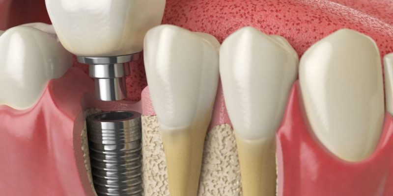 Dental Implants: Why They Are The Best Solution For Damaged Teeth