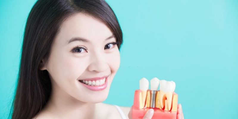 Some Risks To Know Before Opting For Dental Implants