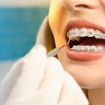 Orthodontics For Adults