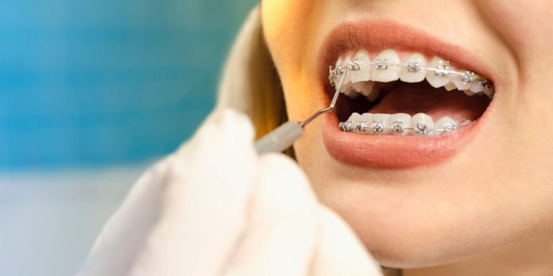 Orthodontics For Adults