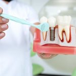 Dental Implants: What You Should Know