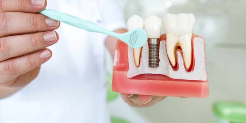 Dental Implants: What You Should Know