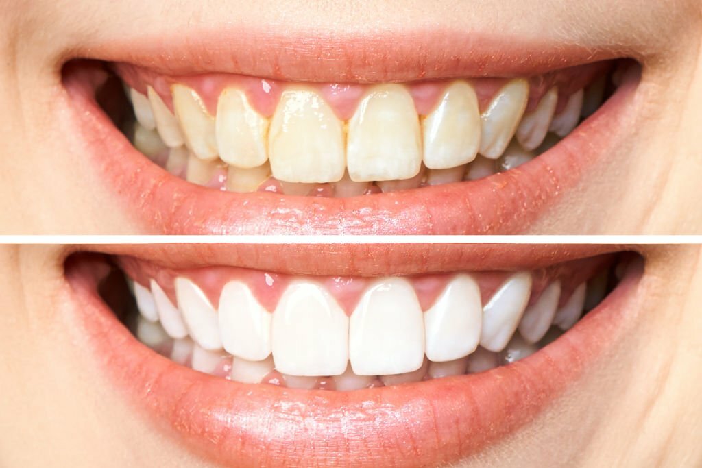 teeth whitening before after