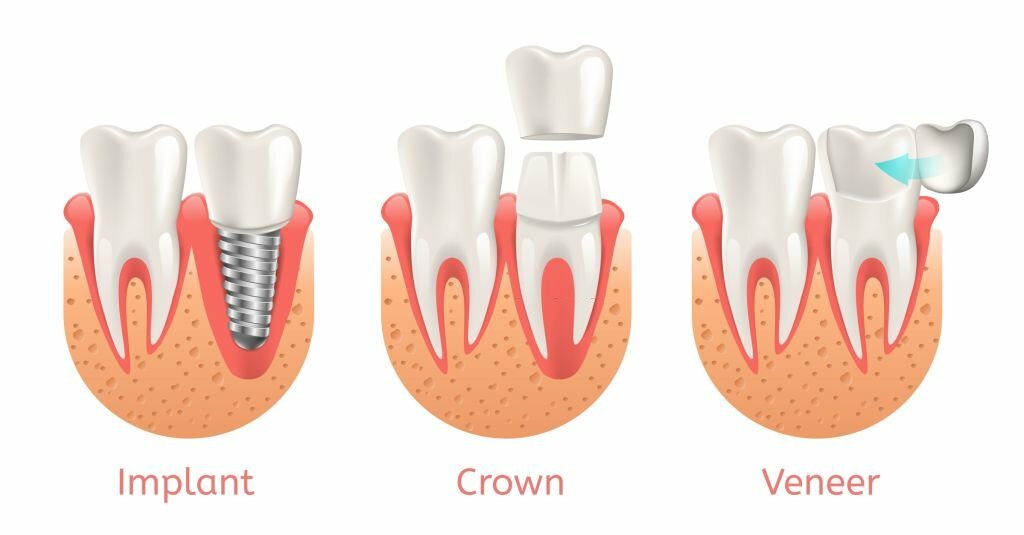 veneers guide