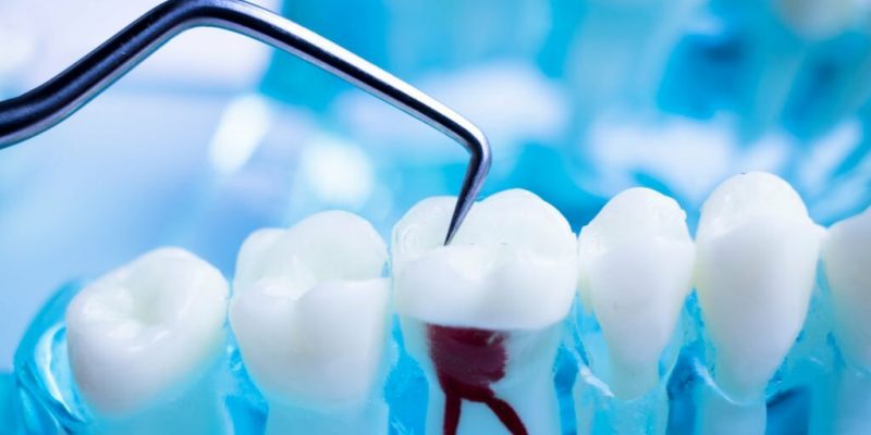 A Comprehensive Guide to Dentistry for Root Canals_FI