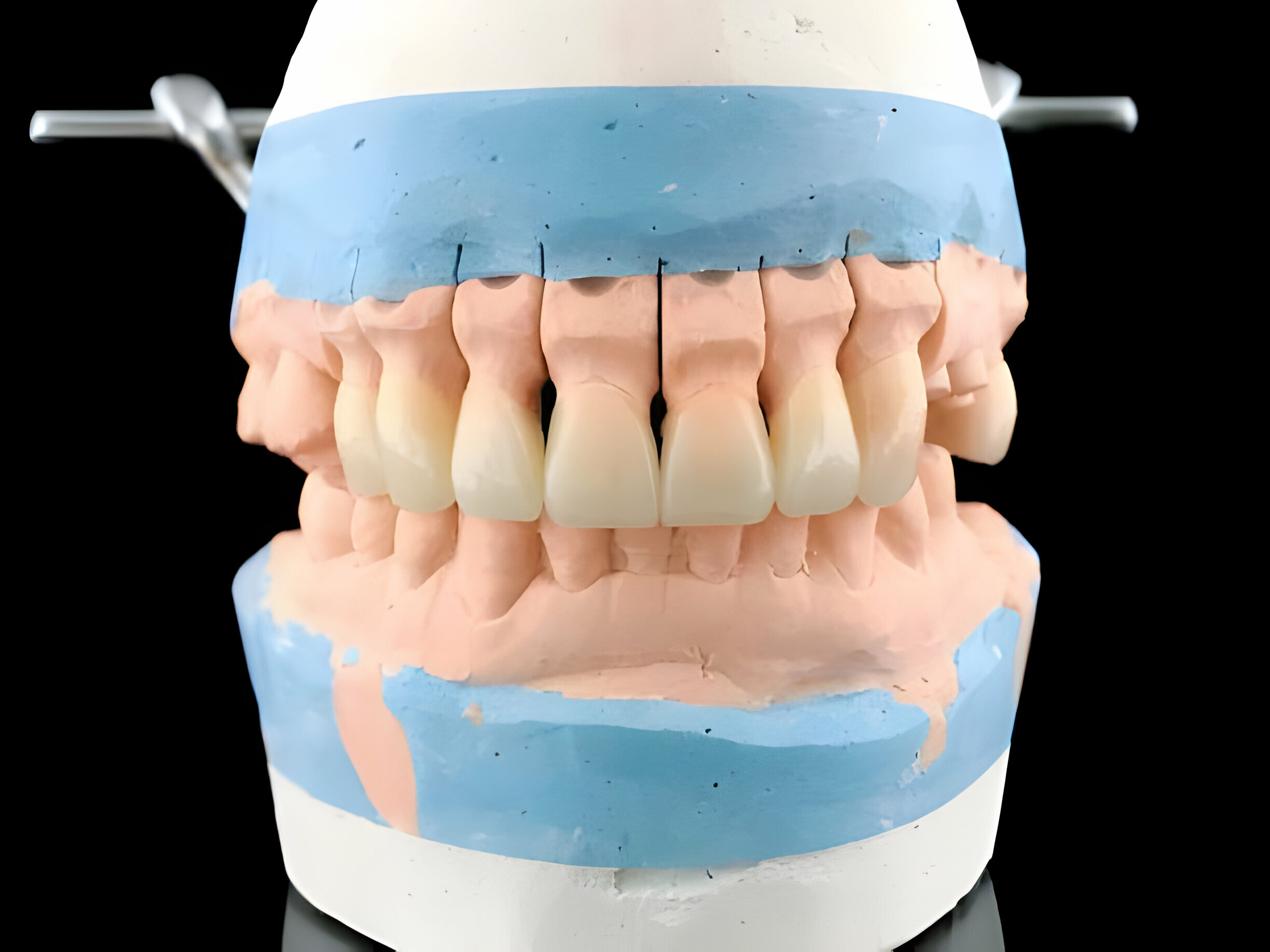 Benefits of Full Dentures vs. Partial Dentures_2