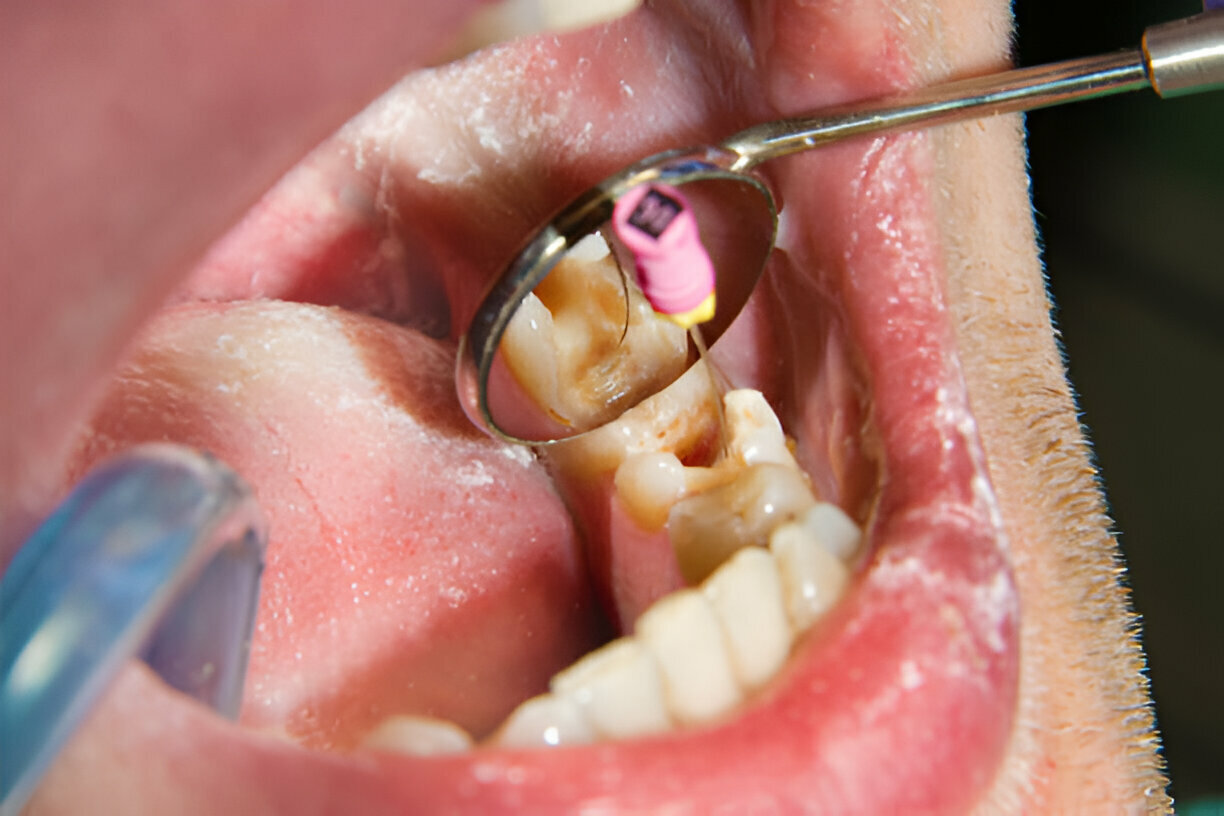Does a Root Canal Hurt? What to Expect at Navarro Dental in Corsicana_1
