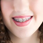 Braces in Corsicana, TX: A Complete Patient Guide to Getting Started_FI
