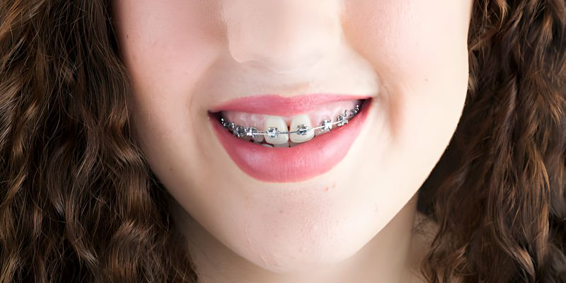 Braces in Corsicana, TX: A Complete Patient Guide to Getting Started_FI
